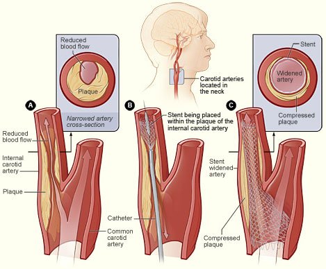 Cad_stentplacement