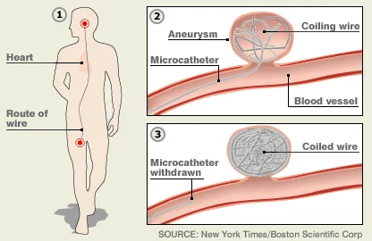 The-endovascular-treatment-of-cerebral-aneurysm-1-insert-a-catheter-into-the-femoral